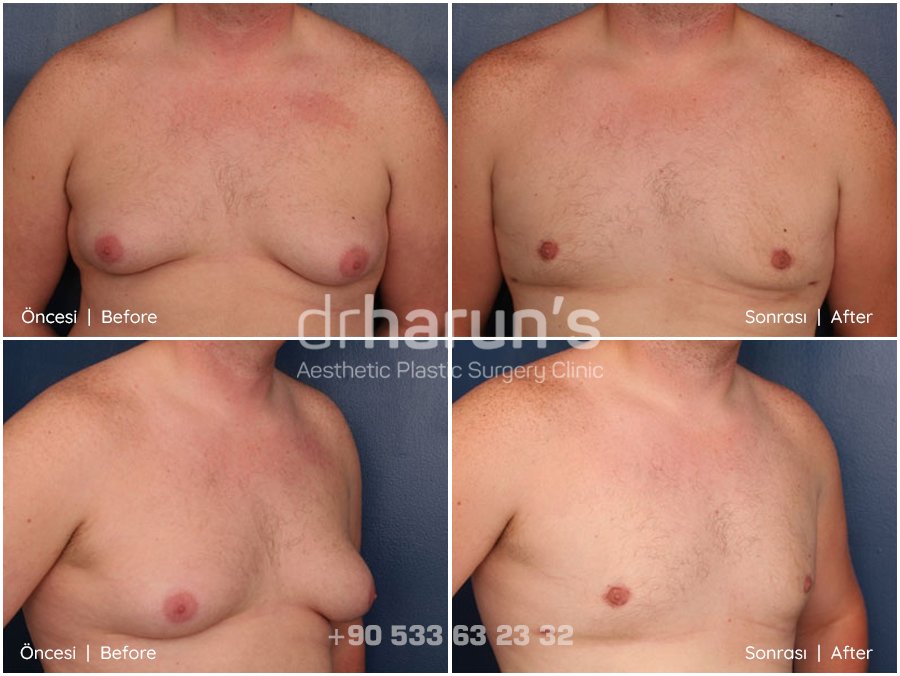 gynecomastia in turkey | before and after photo 1