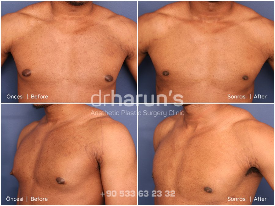 gynecomastia surgery before and after - sample 10