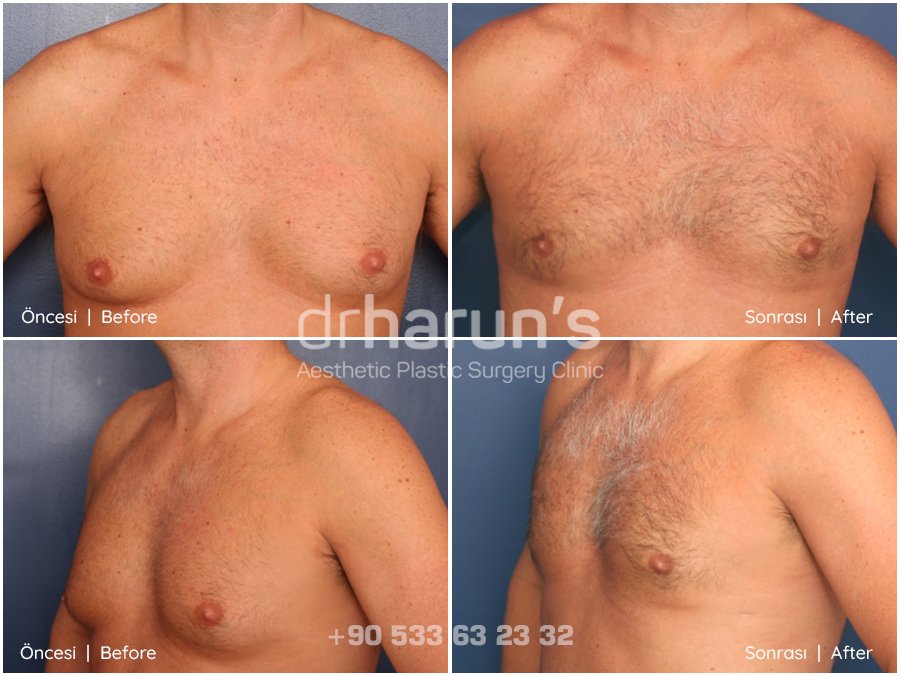 gynecomastia surgery before and after - sample 11