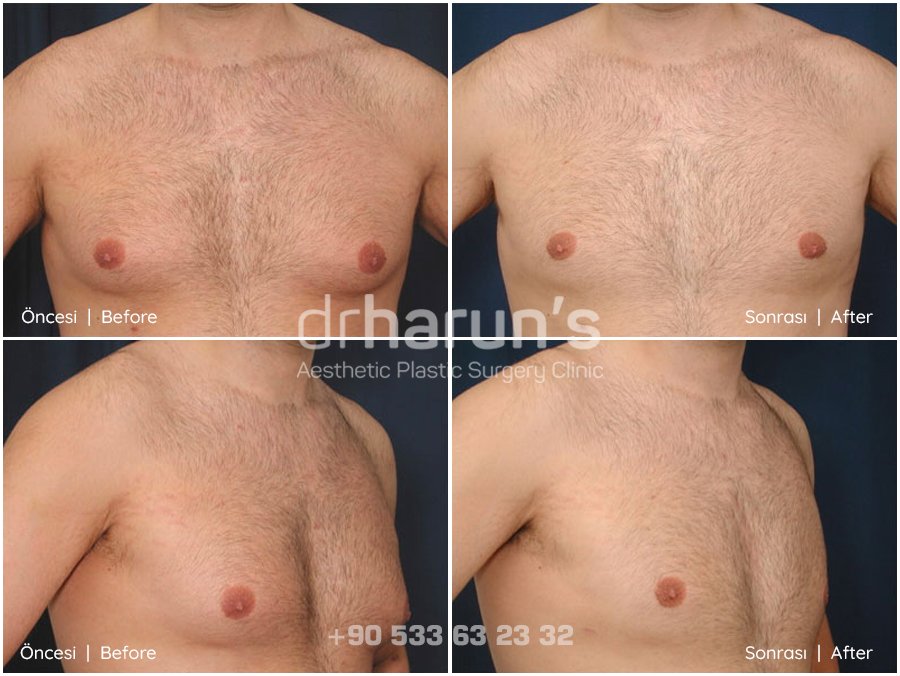 gynecomastia surgery before and after - sample 12