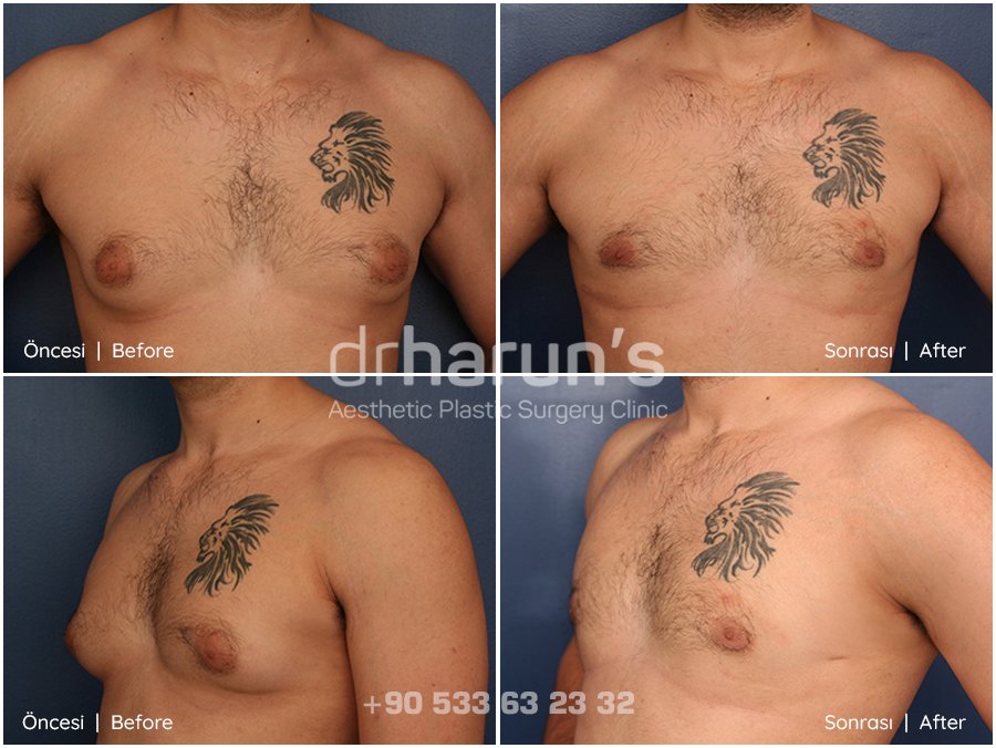 gynecomastia in turkey | before and after photo 2