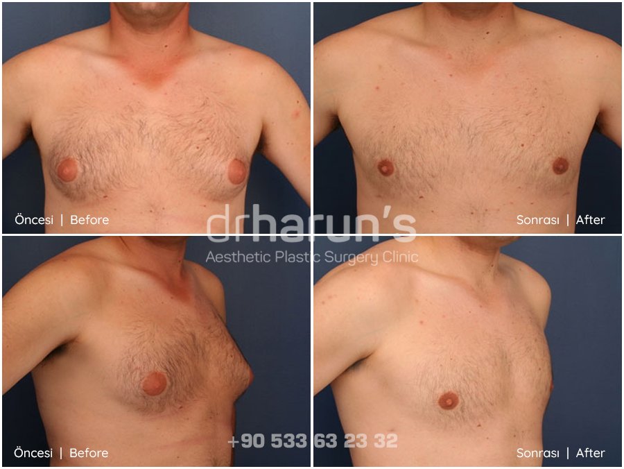 gynecomastia in turkey | before and after photo 3