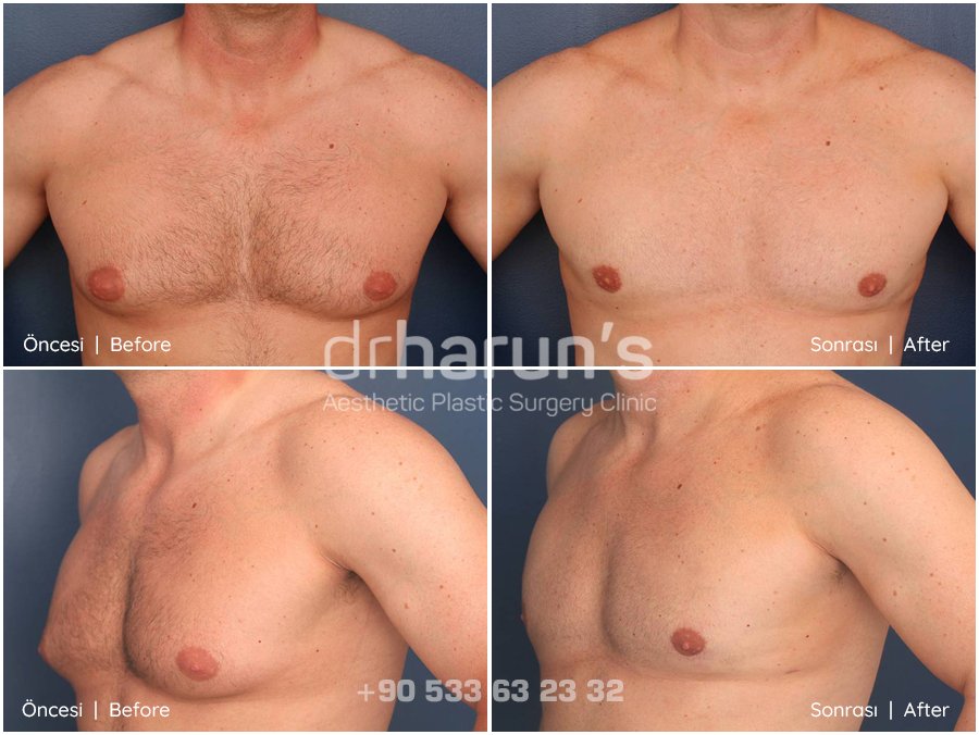 gynecomastia in turkey | before and after photo 4