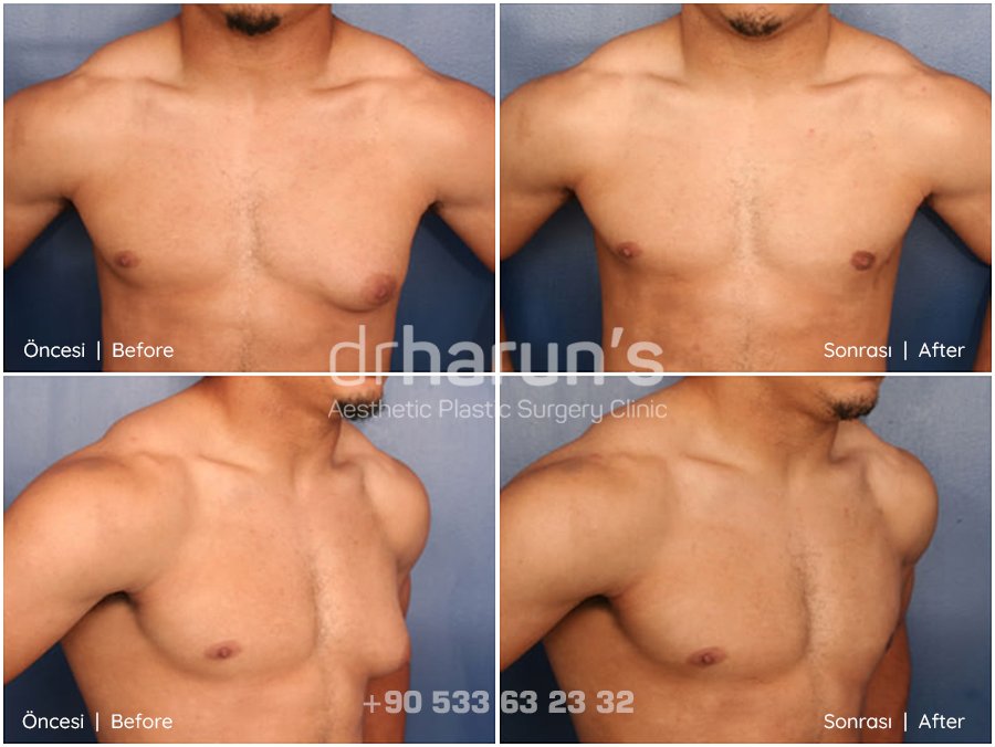 gynecomastia surgery before and after - sample 5