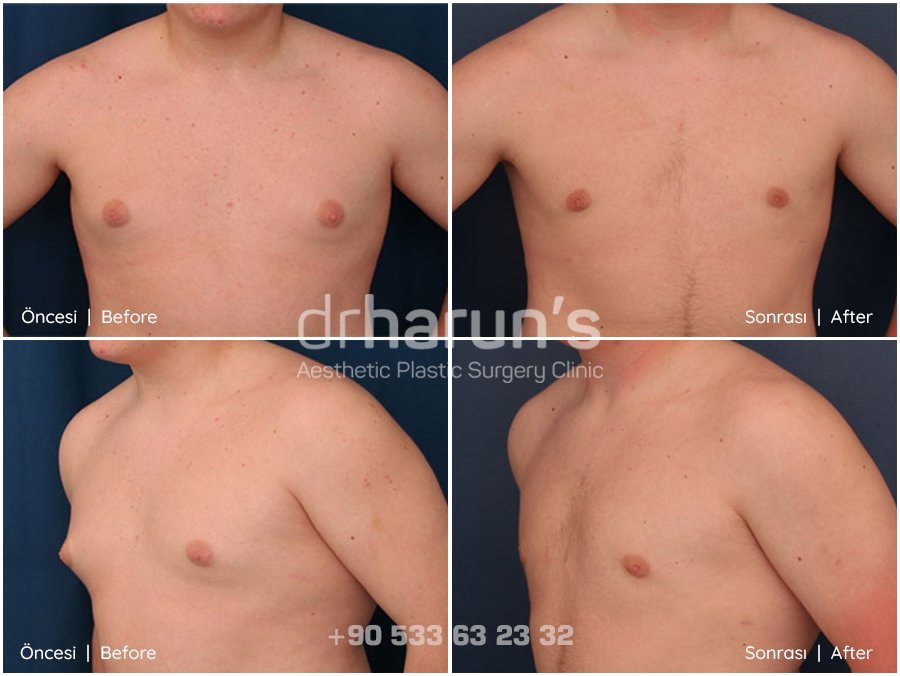 gynecomastia surgery before and after - sample 6