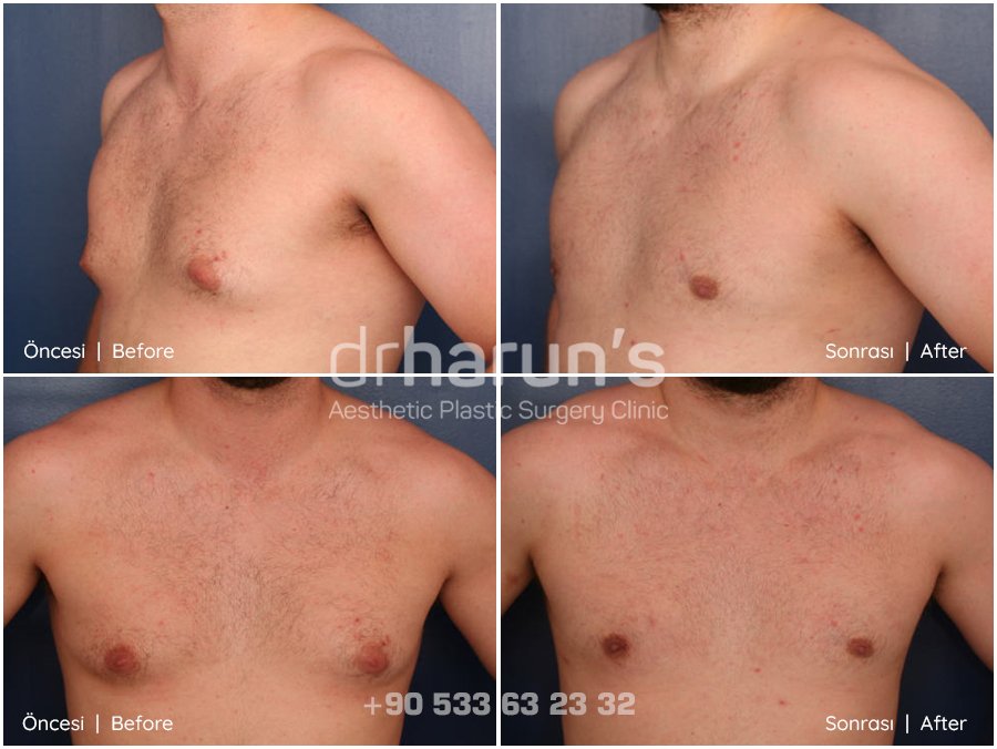 gynecomastia surgery before and after - sample 7