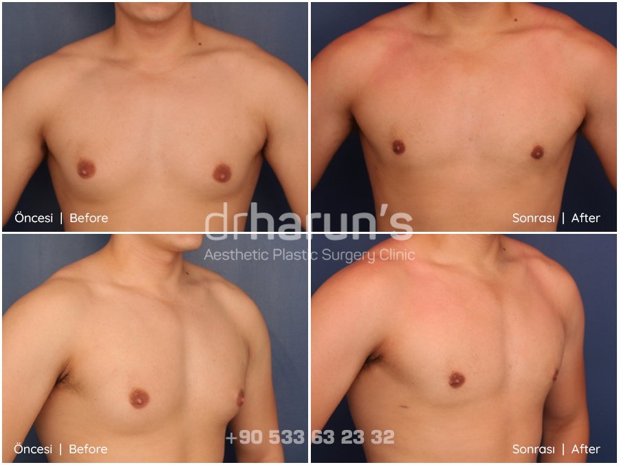 gynecomastia surgery before and after - sample 8