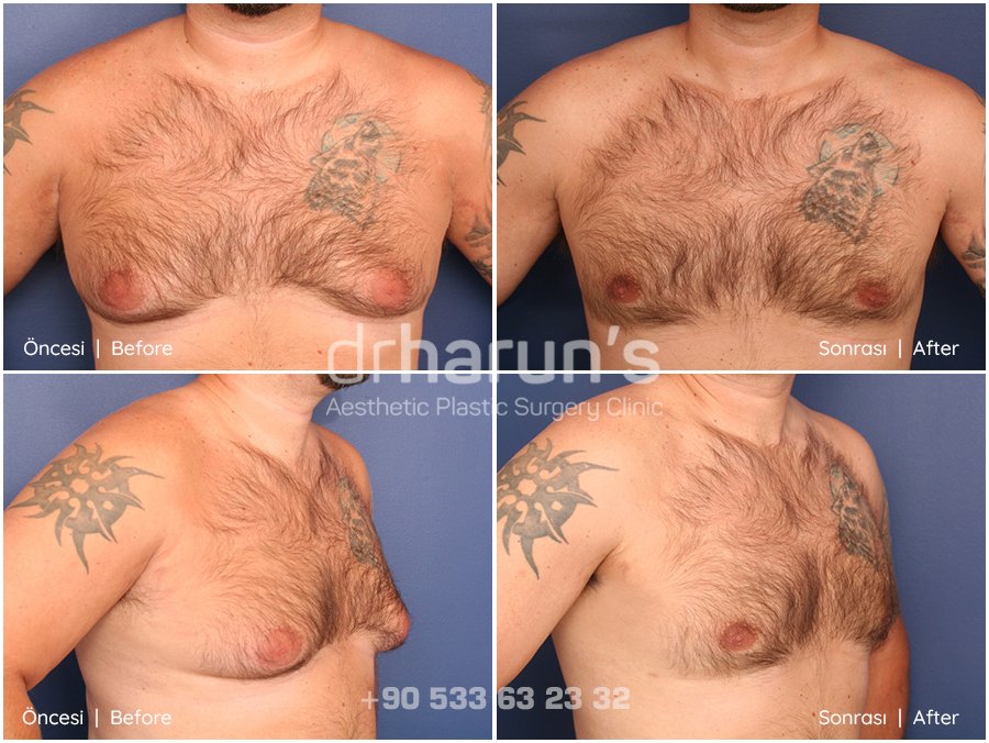 gynecomastia surgery before and after - sample 9