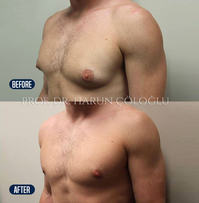 Gynecomastia surgery procedure