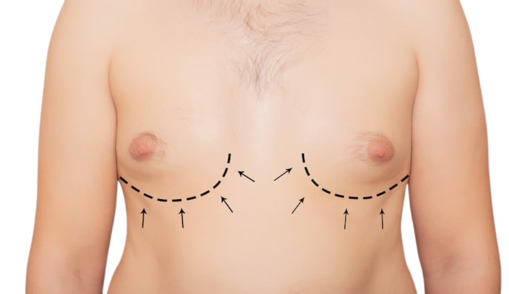 All About Gynecomastia
