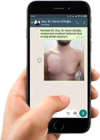 Online gynecomastia consultation via WhatsApp