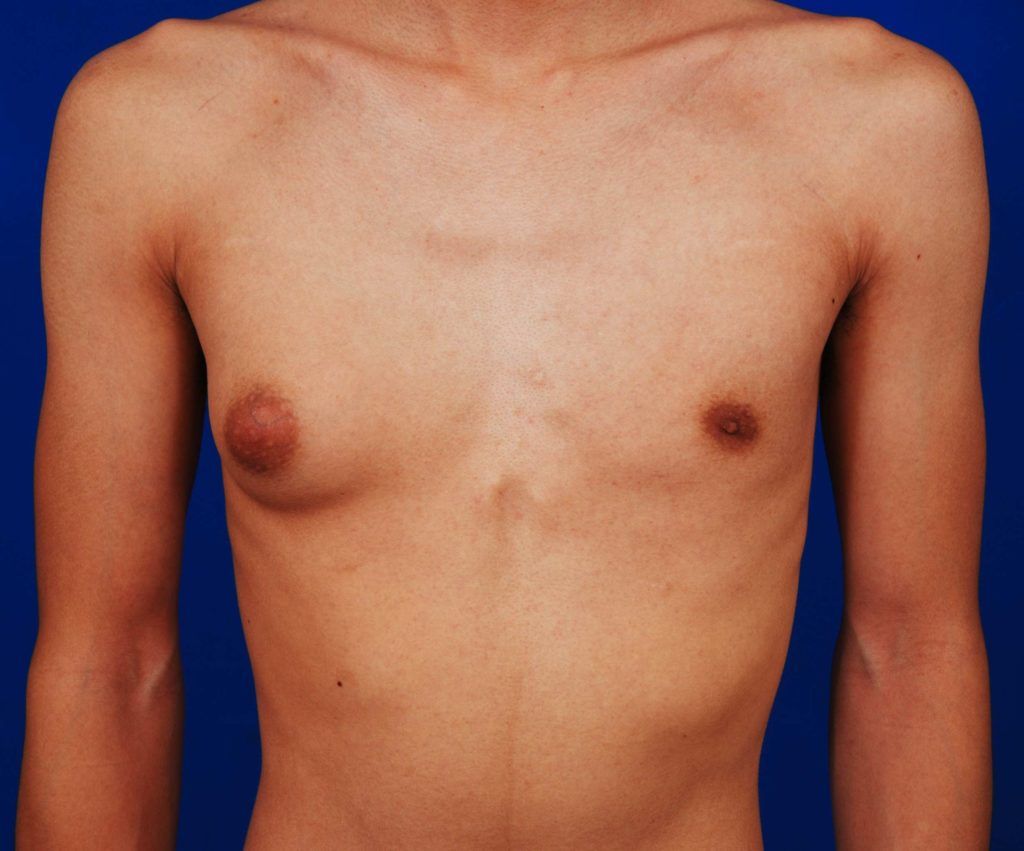 Different the gynecomastia vs cancer